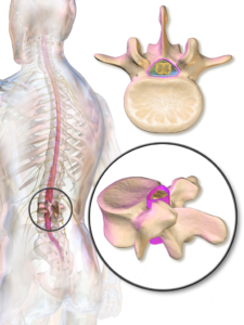 Dura spinal section (Image by Blausen.com staff)